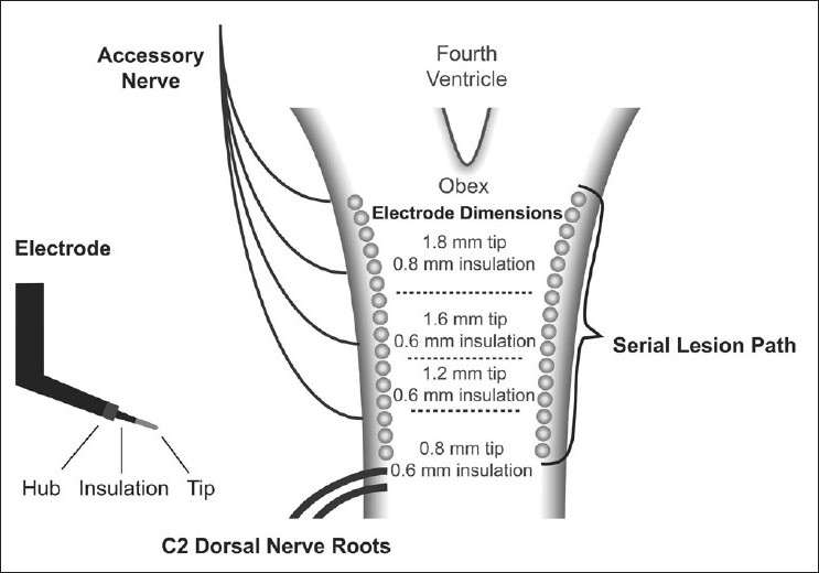 Lesionig Nucleus caudalis lesioning: Case report of chronic traumatic headache ...