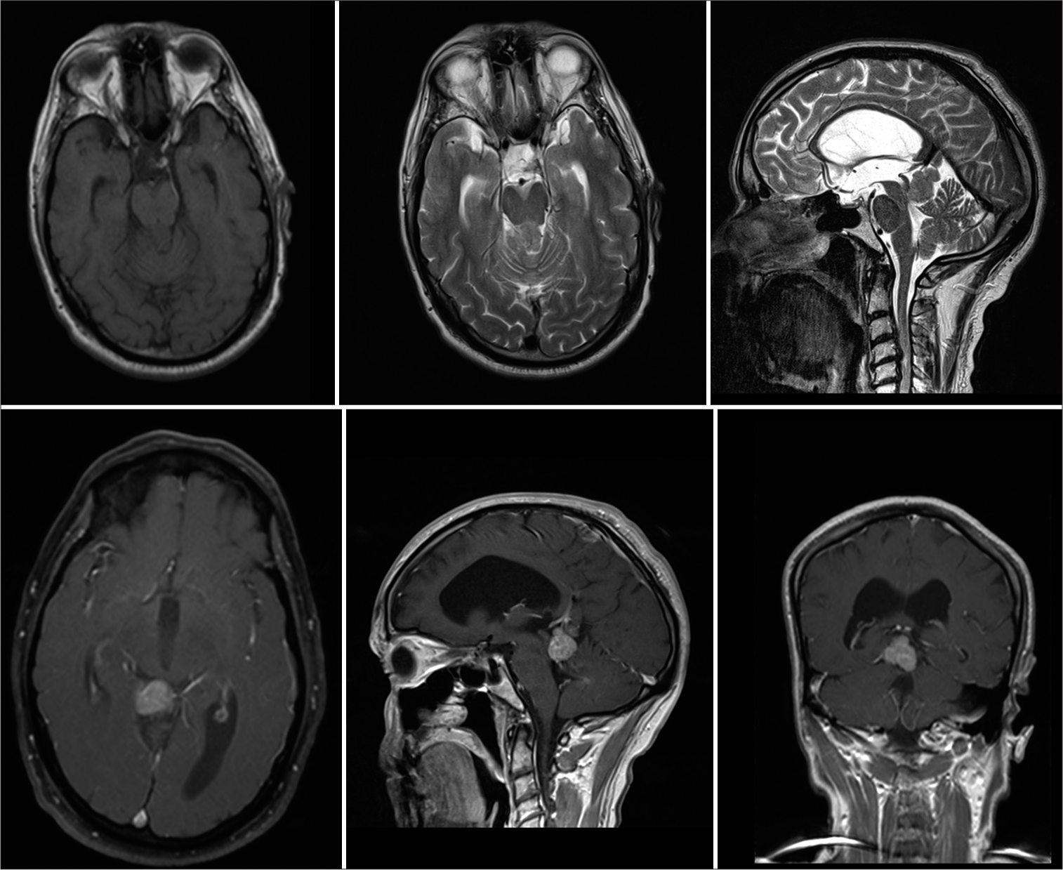 A bi-foraminal craniometric-guided approach to endoscopic third ...