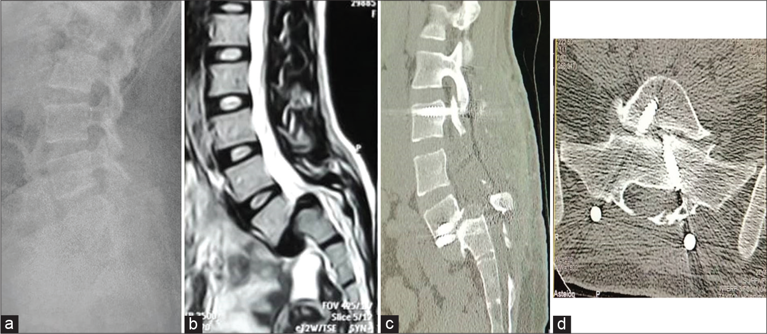 Pedicular lumbosacral spine fusion for adult/adolescent lumbar ...