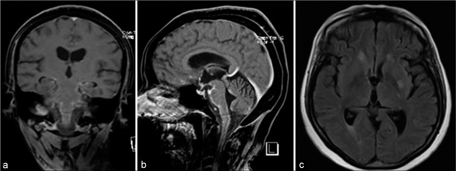 Spinal intramedullary abscess due to Candida albicans in an ...