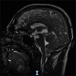 Follow-up of syringomyelia due to Chiari type I malformation with phase ...