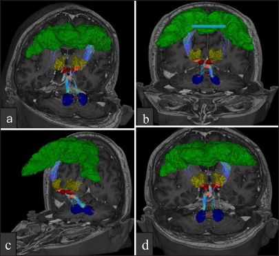 Dentato-rubro-thalamic tract tractography: Constrained spherical ...