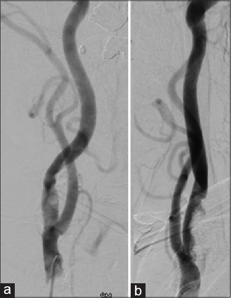 Retained distal protection device during carotid artery stenting ...