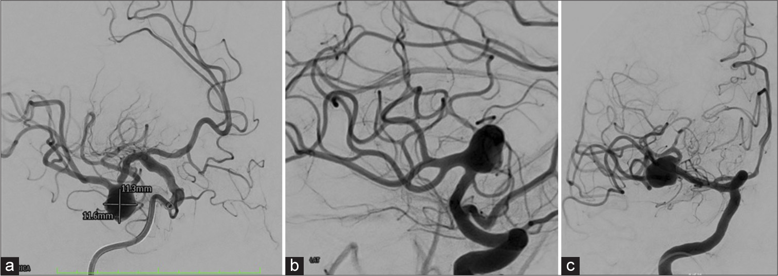 Coiling Assisted Y-stent-assisted coiling for large wide-neck dysplastic middle cerebral ...