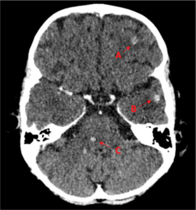 Multiple Abscesses in the Frontal, Temporal and Brainstem regions in a ...